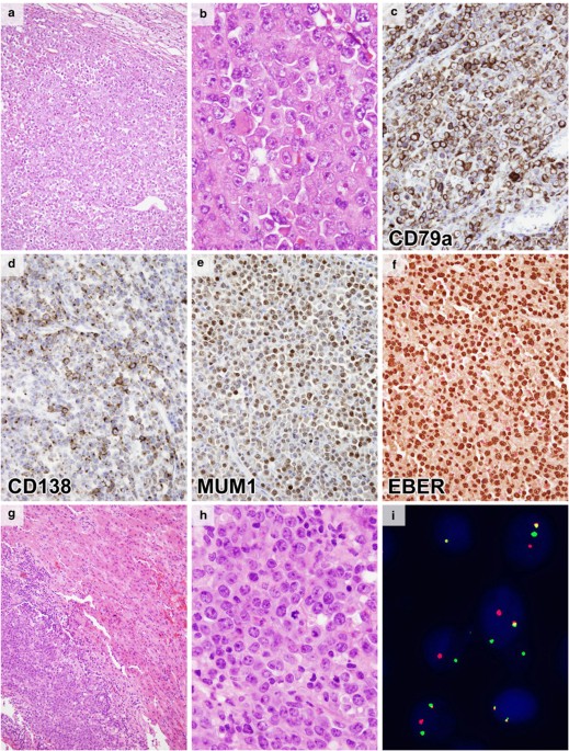 Most primary adrenal lymphomas are diffuse large Bcell