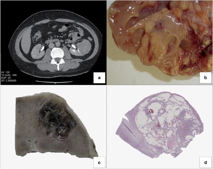t(6;11) renal cell carcinoma a study of seven cases