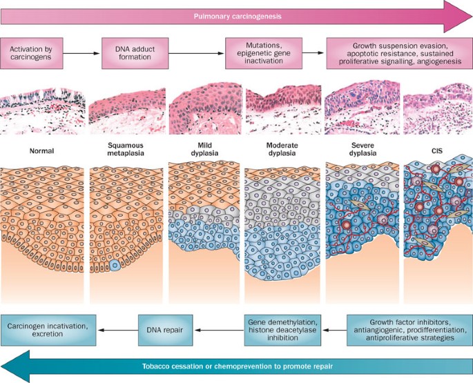 Lung cancer chemoprevention current status and future