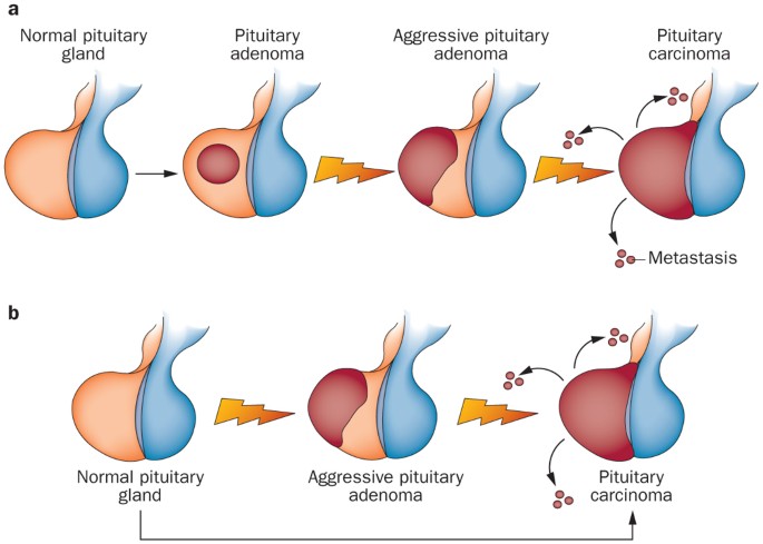 Aggressive pituitary adenomas—diagnosis and emerging