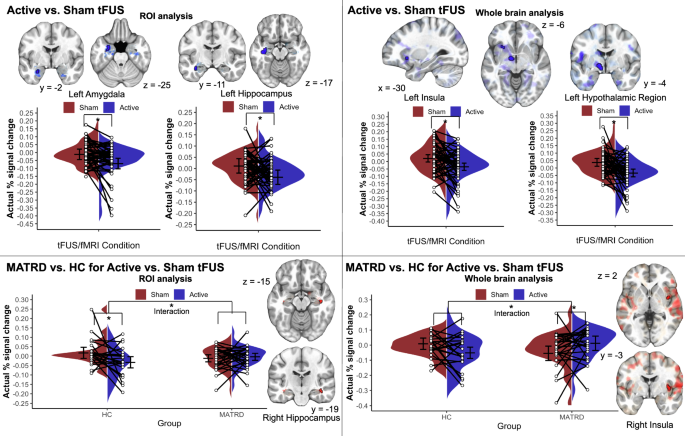 Low-intensity transcranial focused ultrasound amygdala neuromodulation