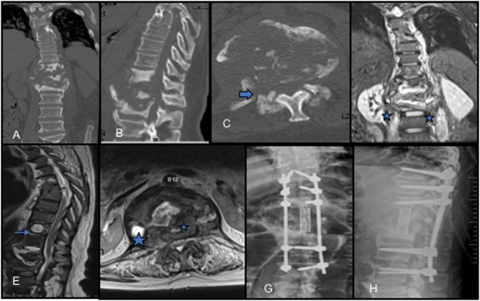 Infected charcot spine arthropathy | Spinal Cord Series ...