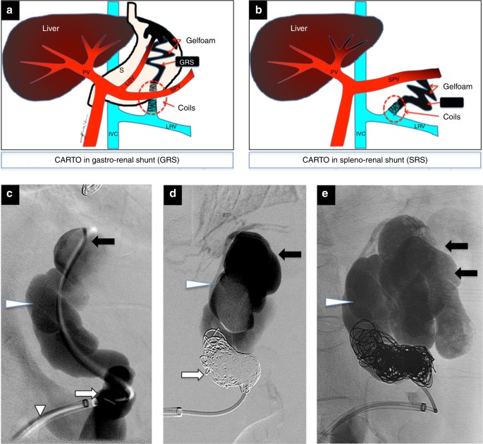 coil assisted retrograde transvenous obliteration coil assisted retrograde transvenous obliteration