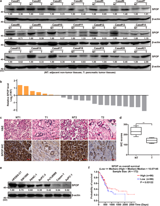 SPOP suppresses pancreatic cancer progression by promoting