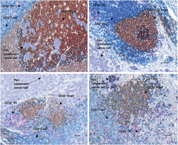Sentinel lymph node B cells can predict disease-free ...