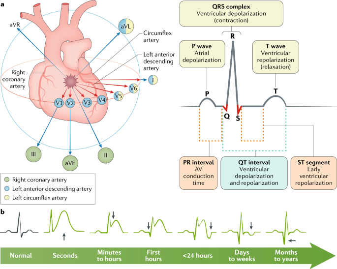 STsegment elevation myocardial infarction Nature