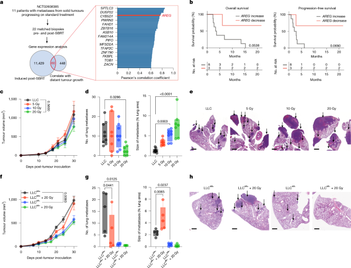 Radiation-induced amphiregulin drives tumour metastasis