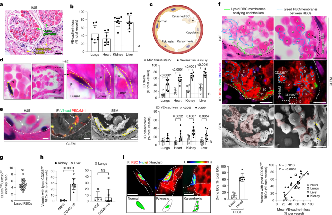 Ischaemic endothelial necroptosis induces haemolysis and COVID-19 angiopathy