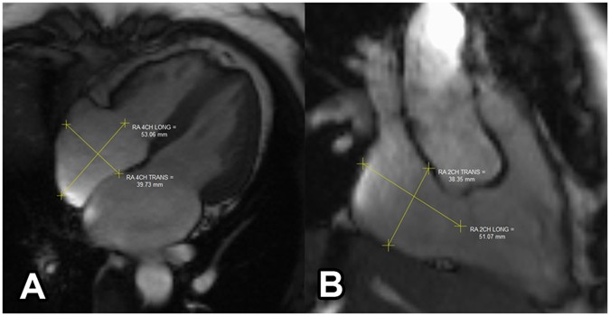 Reference value of left and right atrial size and phasic function by ...