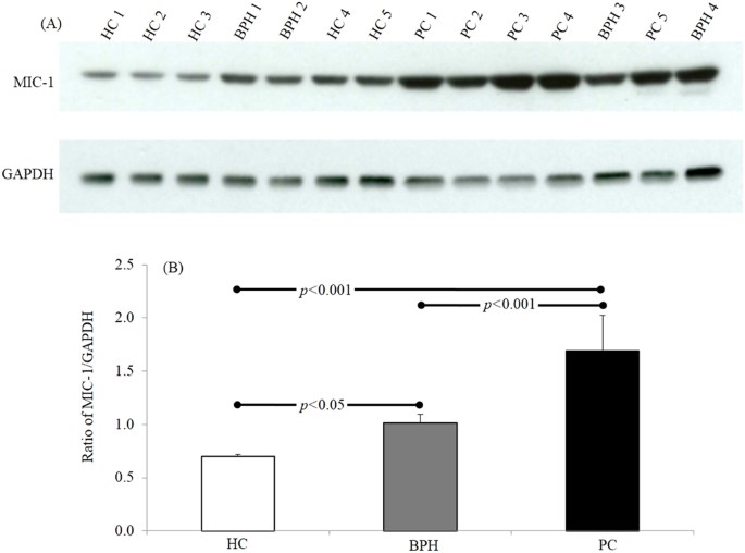 Relevance of MIC1 in the Era of PSA as a Serum Based