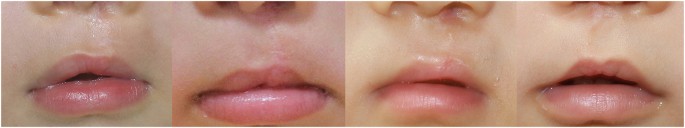 gel silicone cleft lip treatment scars