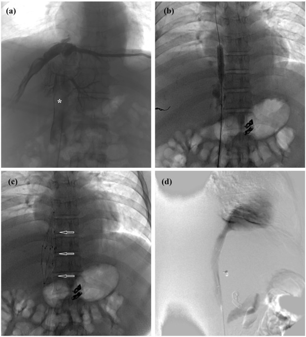 Long-term Outcome of Recoverable stents for Budd-Chiari syndrome Complicated with Inferior Vena ...