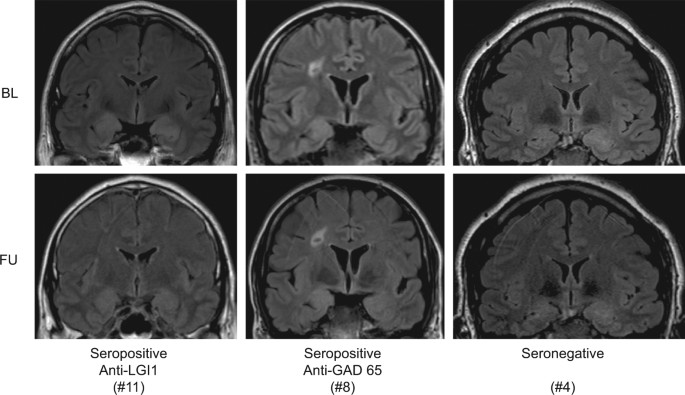 Amygdala enlargement and emotional responses in ...