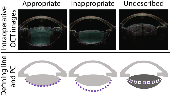 Inspection of the lens thickness with preoperative biometric ...