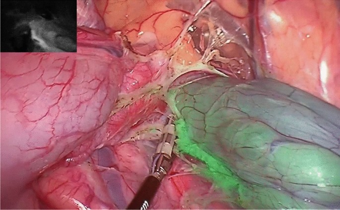 Laparoscopic intraarterial catheterization with selective