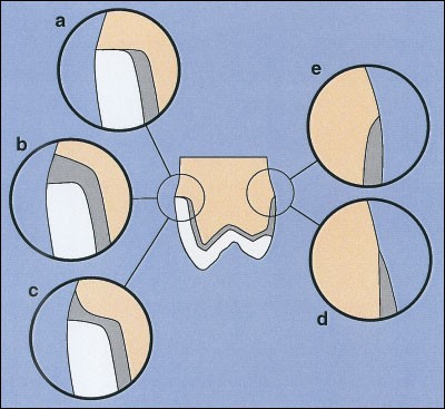 Crowns and other extra-coronal restorations:Preparations for full ...