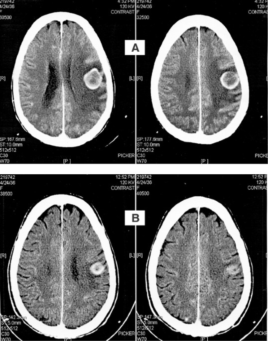 ZD 1839 in patients with brain metastases from non-small ...