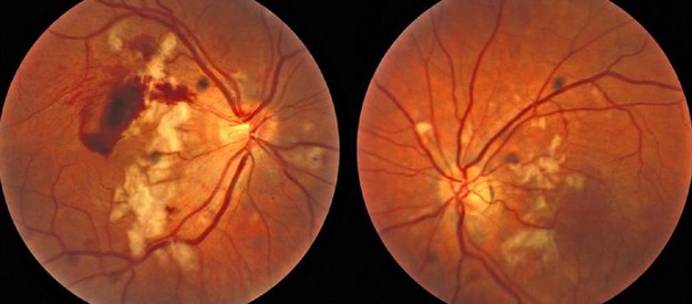 Purtscher�s like retinopathy as the presenting feature of Purtscher�s like retinopathy as the presenting feature of