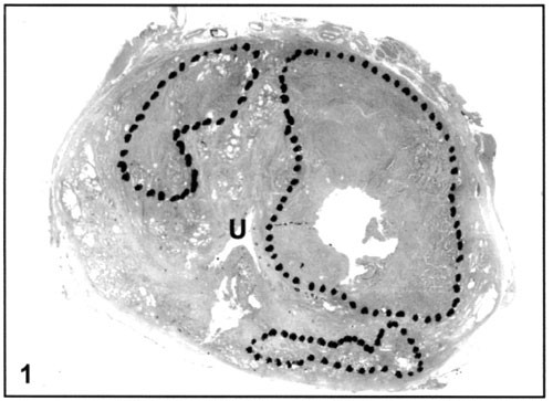 Pathological and clinical characteristics of large ...