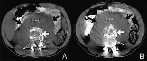 Unusual presentation of ewing s sarcoma 06 picture