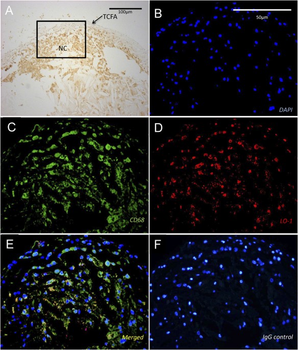 Near-infrared fluorescence imaging of breast cancer (MCF-7 