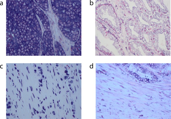 Fibroblast miR-210 overexpression is independently ...