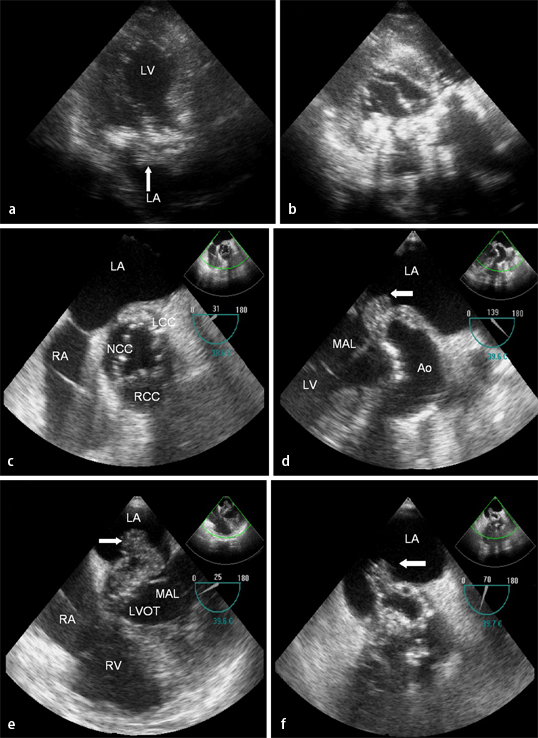 Abscess Block Abscess, aneurysm, fistula, and complete AV block in infective ...