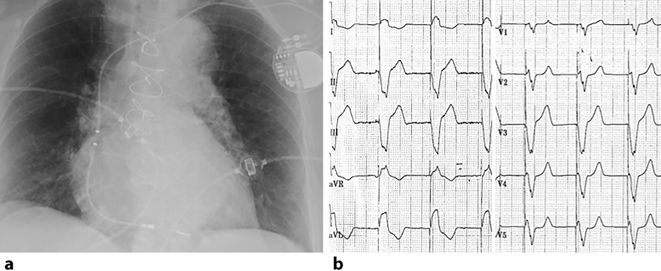 Conduction System Pacing (CSP) für alle Patienten? | springermedizin.de