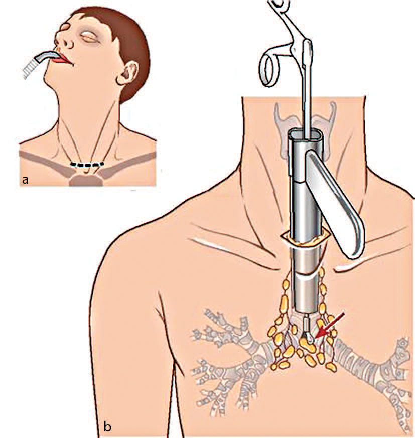 Neck Dissection Ein Wichtiges Behandlungskonzept SpringerLink neck-dissection-ein-wichtiges-behandlungskonzept-springerlink