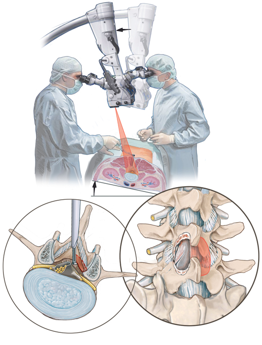 Selektive, mikrochirurgische „Crossover“Dekompression mehrsegmentaler lumbaler Spinalstenosen