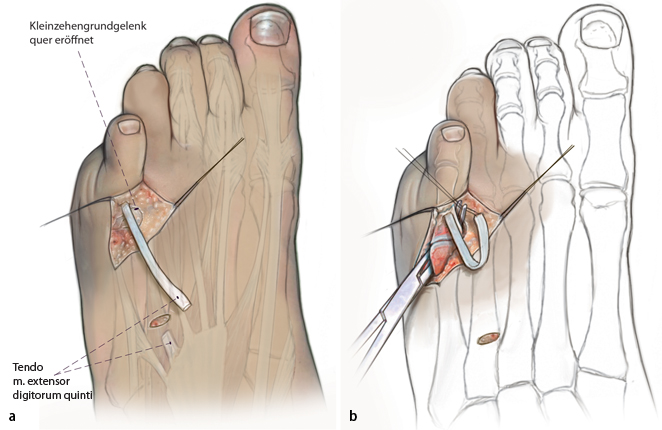Transfer der Extensor-digitorum-longus-Sehne zur Behandlung des ...