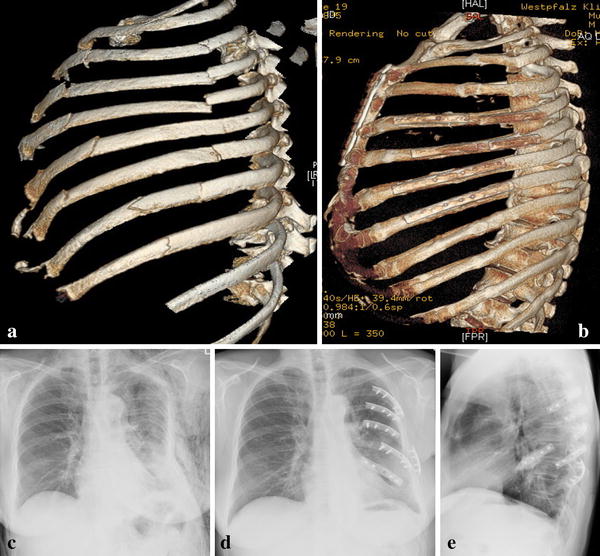 Severe trauma of the chest wall surgical rib stabilisation versus non