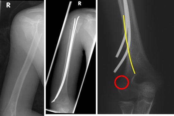 Elastic stable intramedullary nailing (ESIN) in the adolescent patient ...