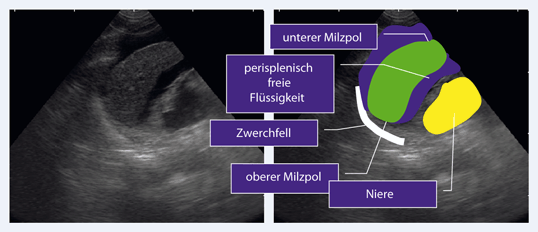 Pr klinische Notfallsonographie Bei Traumatologischen Patienten pr-klinische-notfallsonographie-bei-traumatologischen-patienten