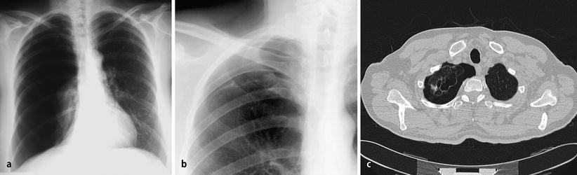 Behandlung des Pneumothorax SpringerLink