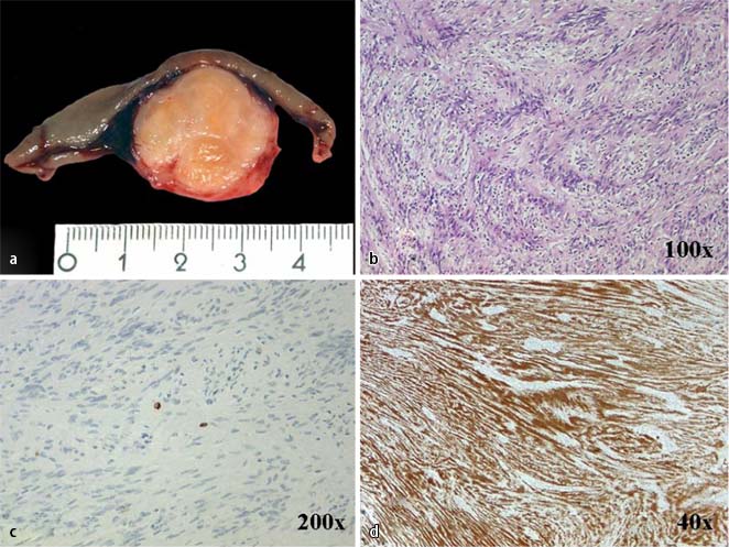 Abdominelles Schwannom SpringerLink