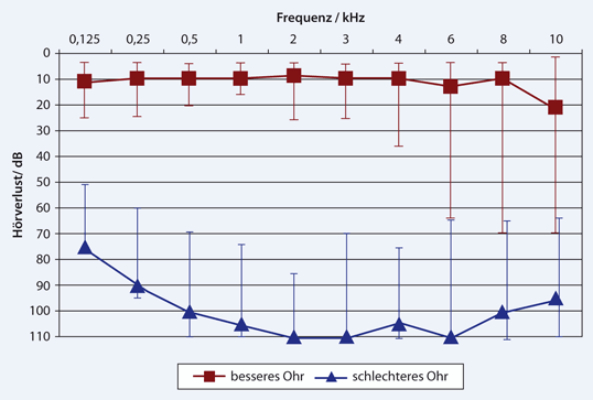 Einseitige Taubheit und Cochlear-implant-Versorgung | SpringerLink