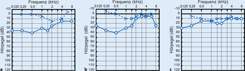 Seltene Differenzialdiagnose einer Schallleitungsschwerhörigkeit im