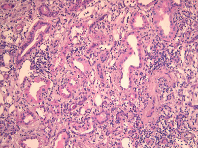 Interstitielle Nephritis SpringerLink