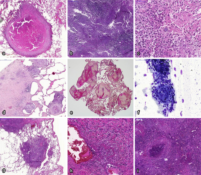 Granulomatöse Lungen Und Systemerkrankungen Springer For Research And Development