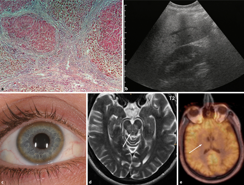 Morbus Wilson SpringerLink