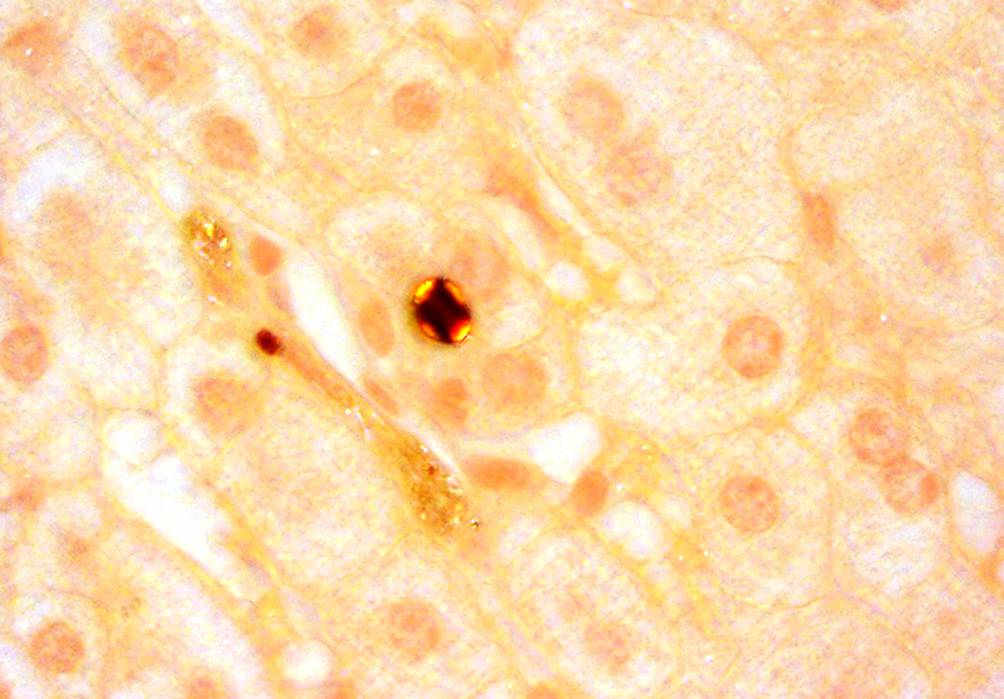 Photodermatosen | Porphyrien | springermedizin.de