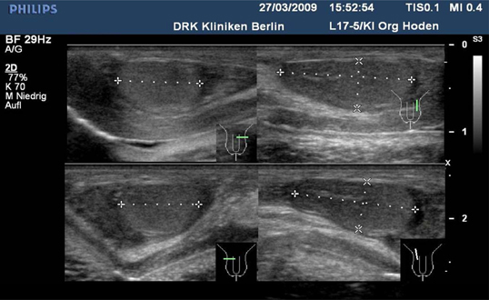 Neugeborener Junge mit UllrichTurnerSyndrom? SpringerLink