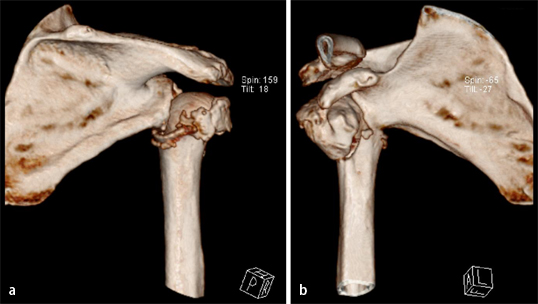 Fraktur Des Proximalen Endes Des Humerus link.springer.com