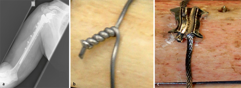 Versorgung periprothetischer und periimplantärer Frakturen | SpringerLink