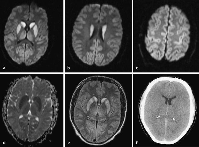 Hypoxischer Hirnschaden Nach Reanimation Prognose link.springer.com