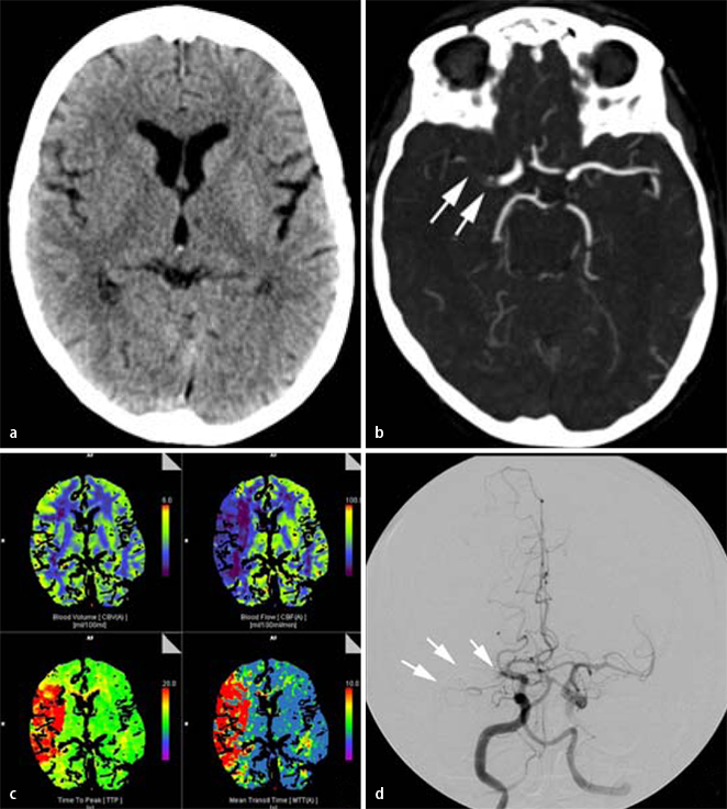 neurologische-notf-lle-in-der-mehrschichtcomputertomographie-springerlink