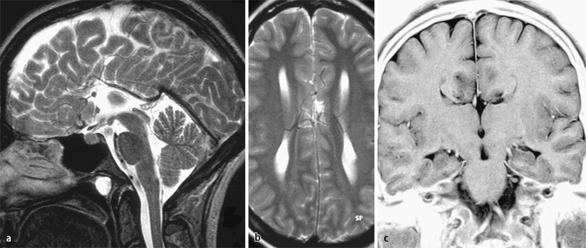 Corpus callosum SpringerLink
