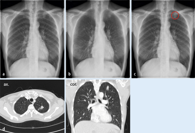 Was Ist Ein Pulmonaler Rundherd