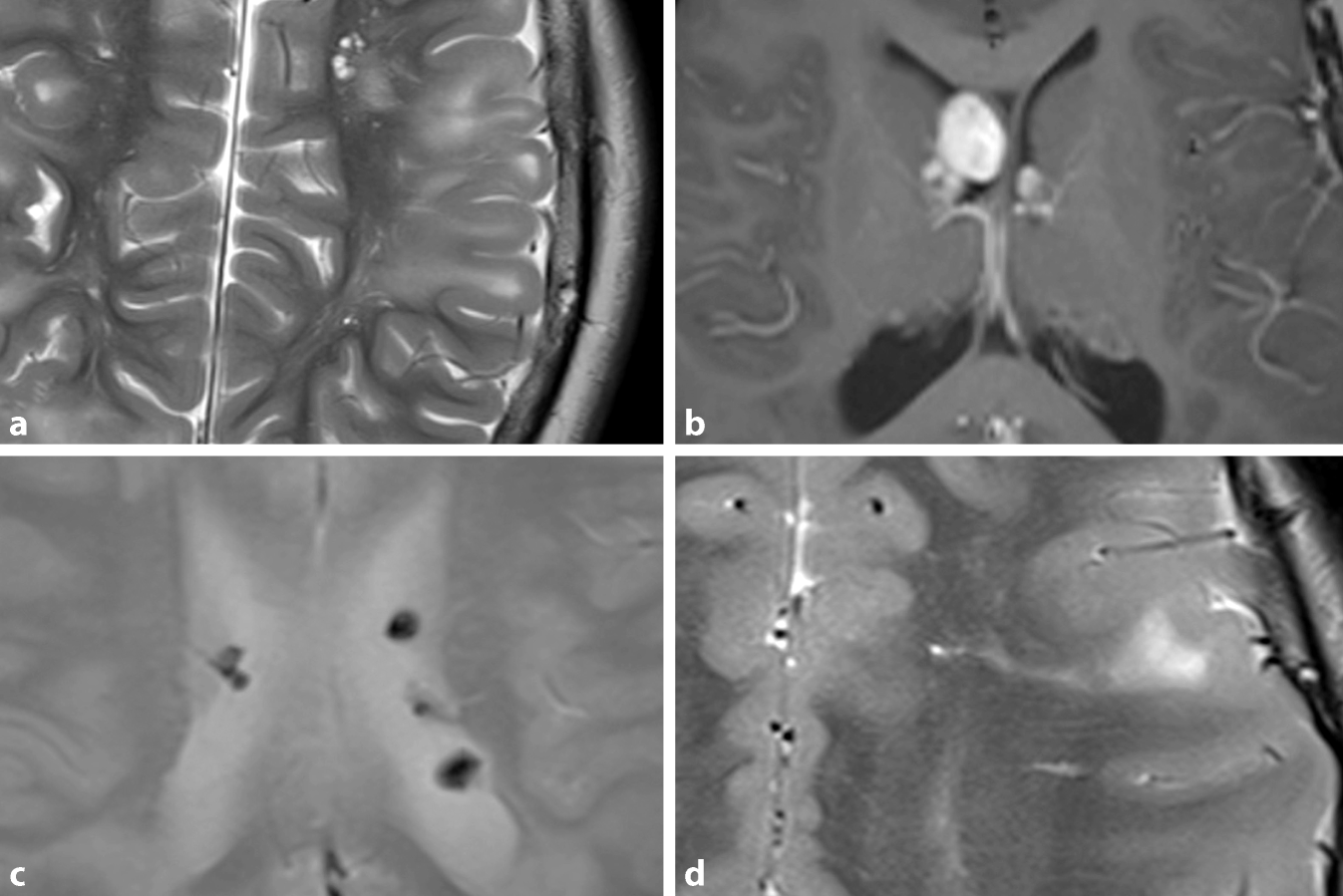 Zns Manifestationen Der Phakomatosen Springerlink